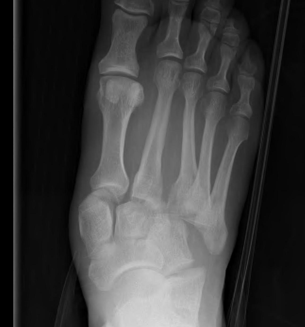 Lis Franc Homolateral